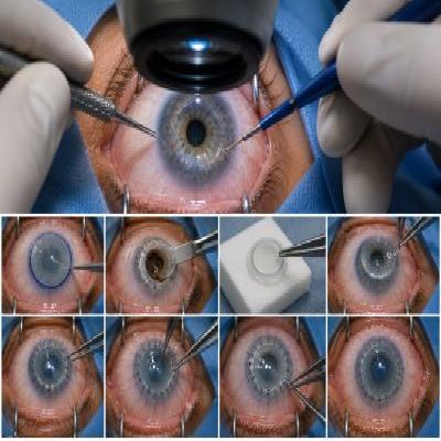 Surgical Procedure